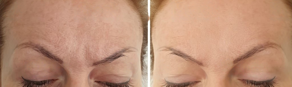 Botox Before and After in Aurora