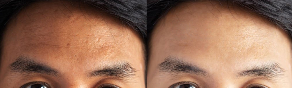 Botox Before and After in Markham