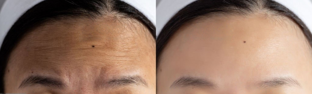 Botox Before and After in Richmond Hill