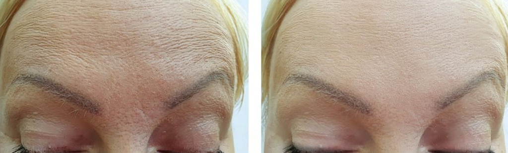 Botox Before and After in Toronto