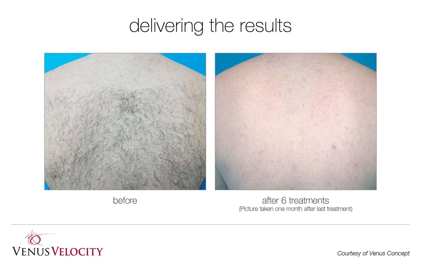 Laser Hair Removal in Richmond Hill Before and After Results Back 1