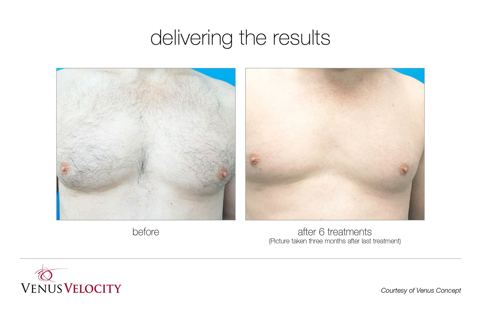 Laser Hair Removal in Richmond Hill Before and After Results Chest 1