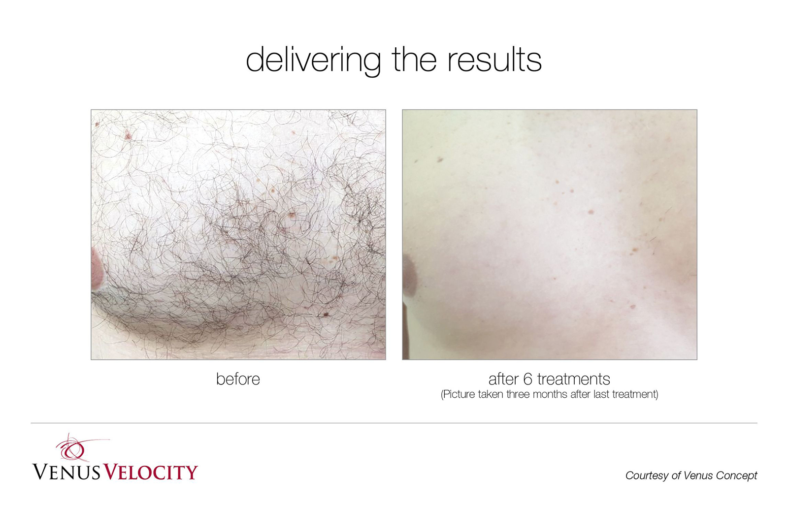 Laser Hair Removal in Richmond Hill Before and After Results Chest 2