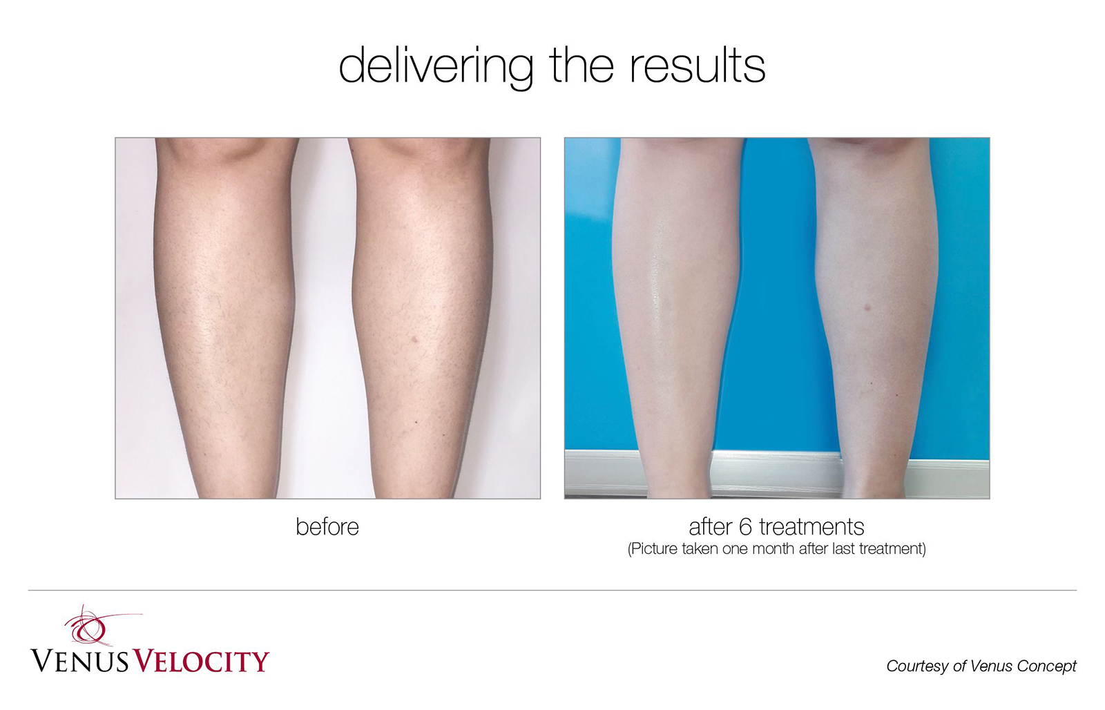 Laser Hair Removal in Richmond Hill Before and After Results Legs