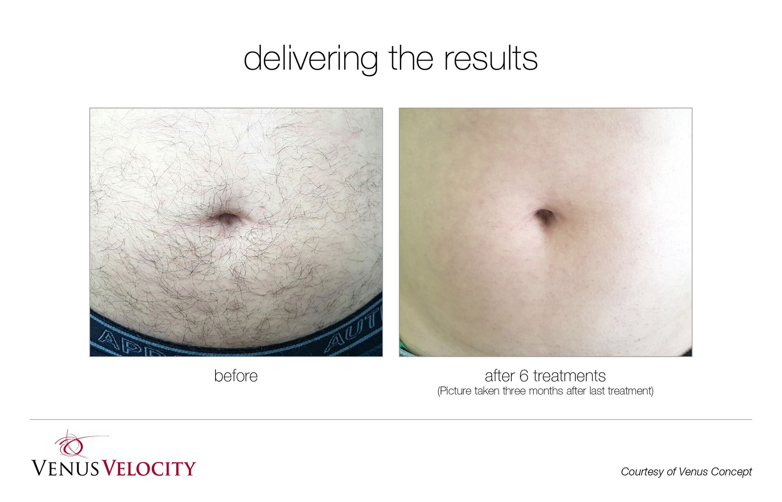 Laser Hair Removal in Richmond Hill Before and After Results Stomach