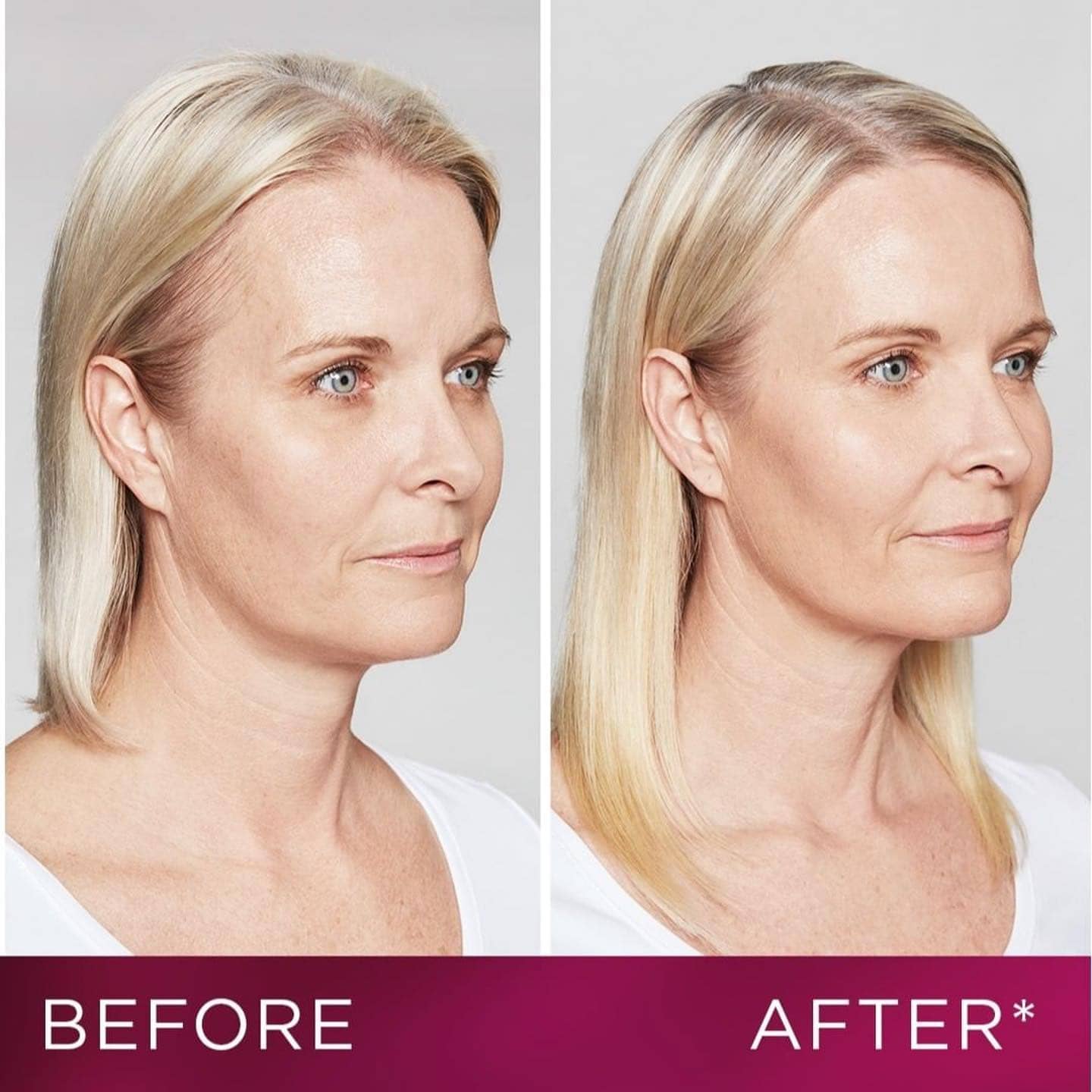 Sculptra Before and After Results in Richmond Hill