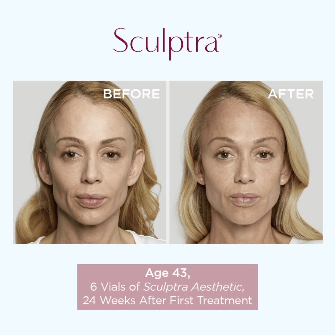 Sculptra Before and After Results 2 in Richmond Hill