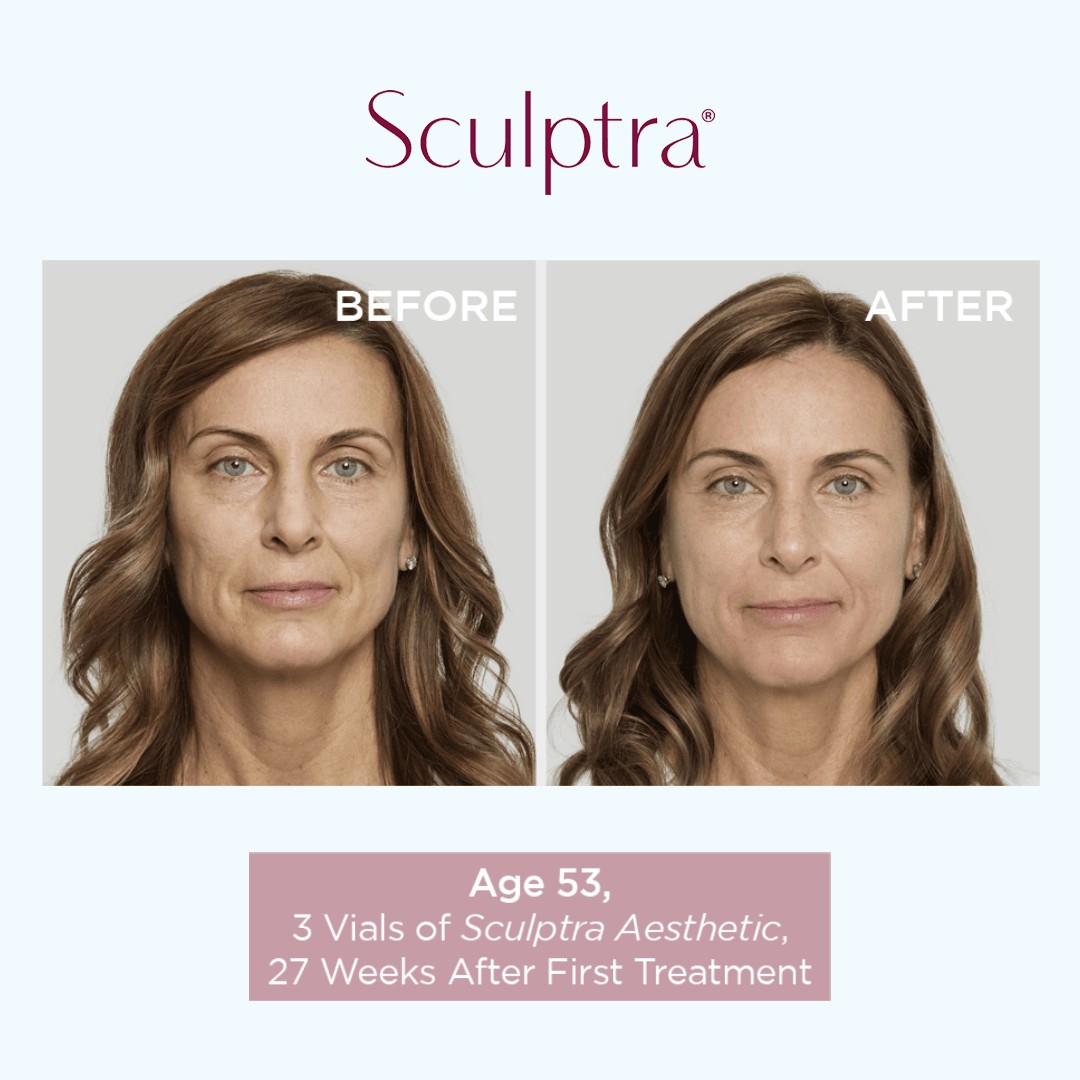 Sculptra Before and After Results 3 in Richmond Hill
