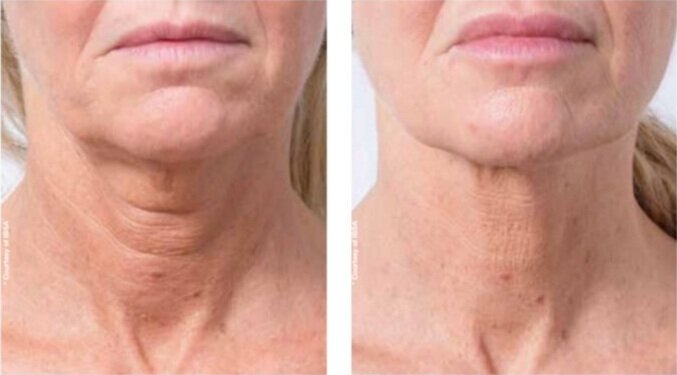 Profhilo in Richmond Hill results on neck displaying reduced skin laxity and increased smoothness