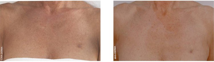 Profhilo in Richmond Hill effects on décolletage with enhanced skin radiance and elasticity