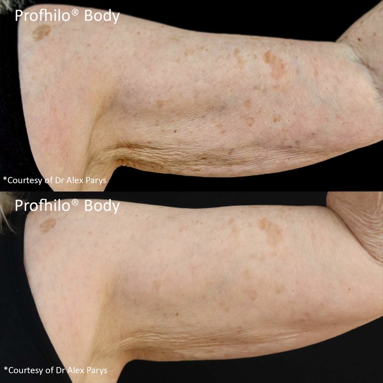 Profhilo treatment on arms showing smoother and firmer skin