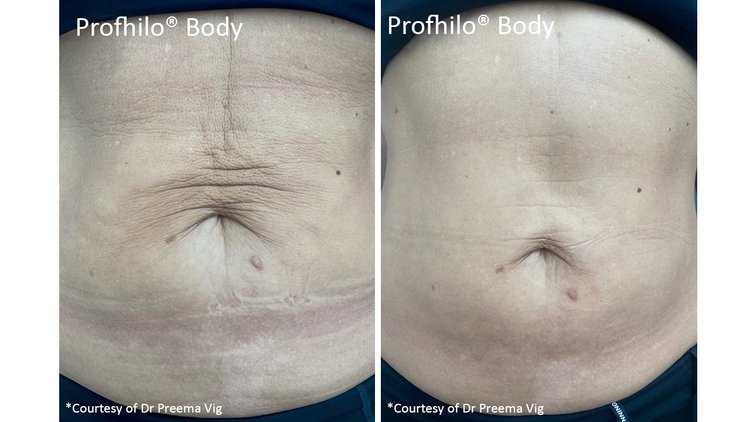 Results of Profhilo in Richmond Hill on abdomen with reduced crepe-like skin and better elasticity