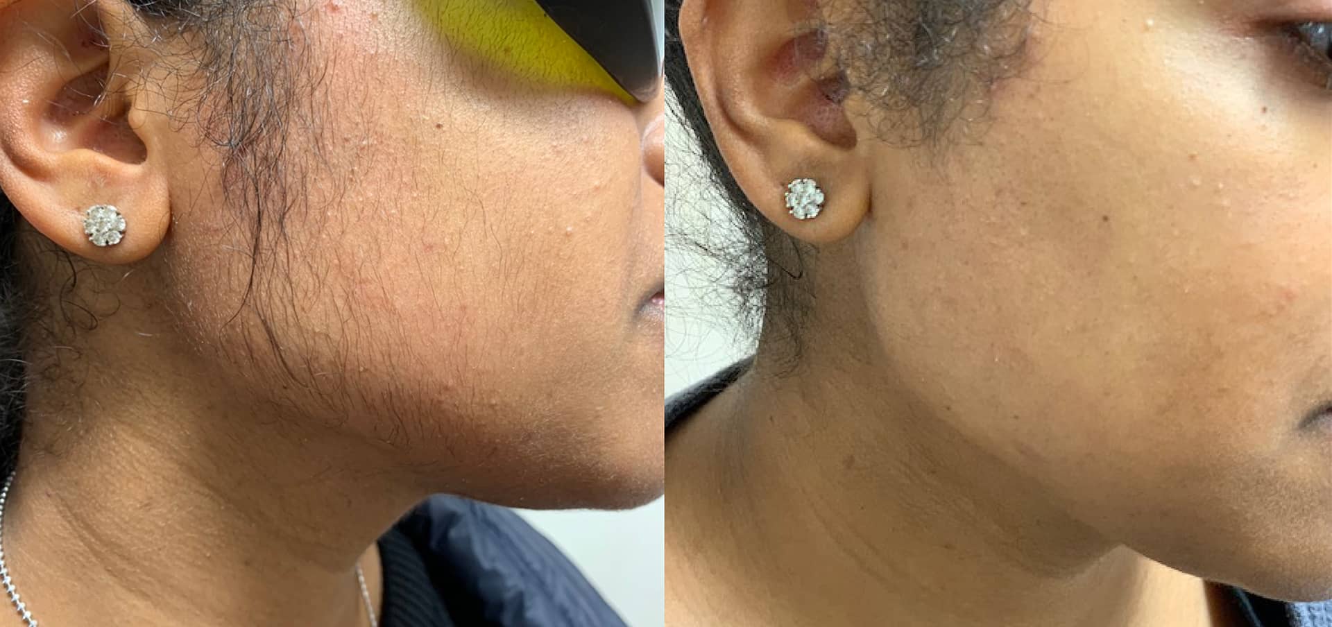 Before and after laser hair removal on the cheeks in Richmond Hill, demonstrating a smooth and even skin tone.