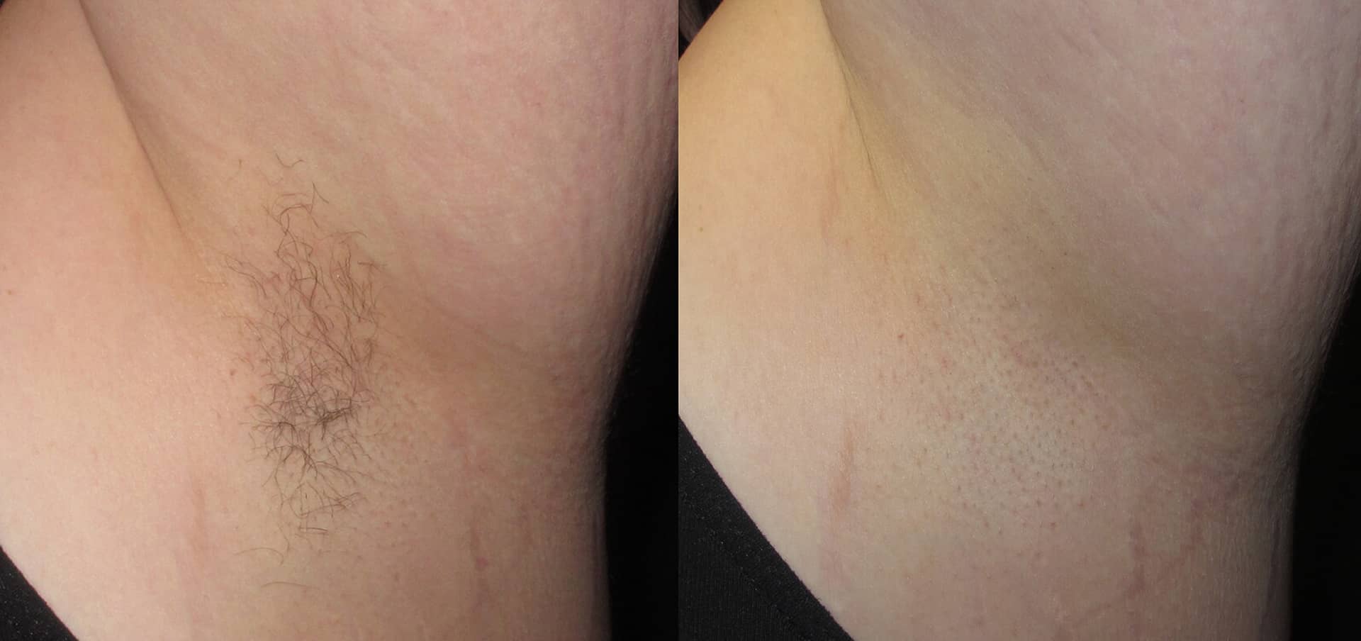 Before and after laser hair removal on the underarms in Richmond Hill, showing hair-free and smooth skin.