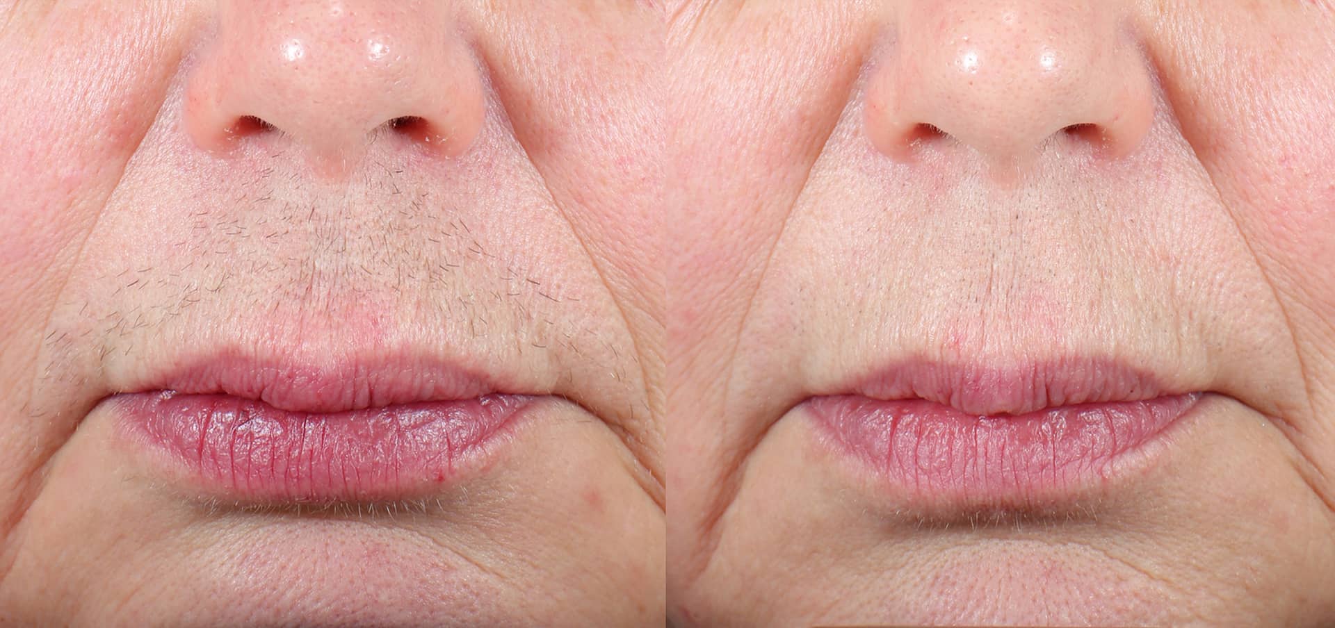 Before and after laser hair removal on the upper lip in Richmond Hill, highlighting reduced hair and clear skin.