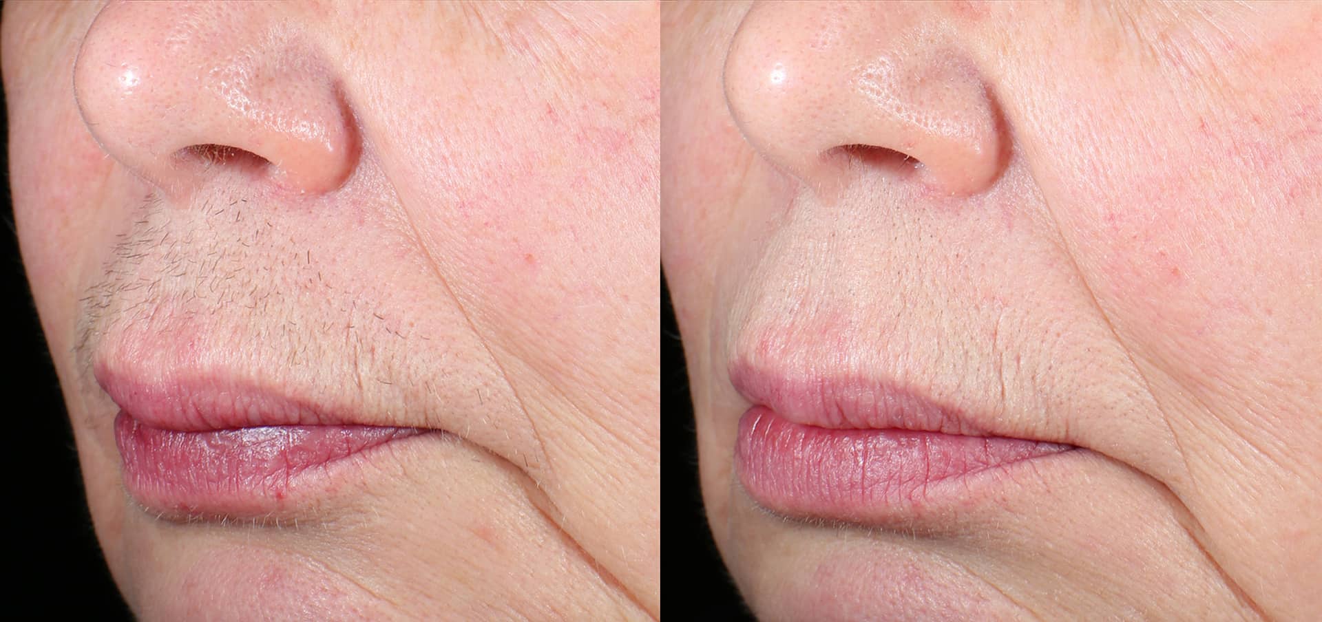 Laser hair removal Before and after results on the upper lip in Richmond Hill, highlighting reduced hair and clear skin.