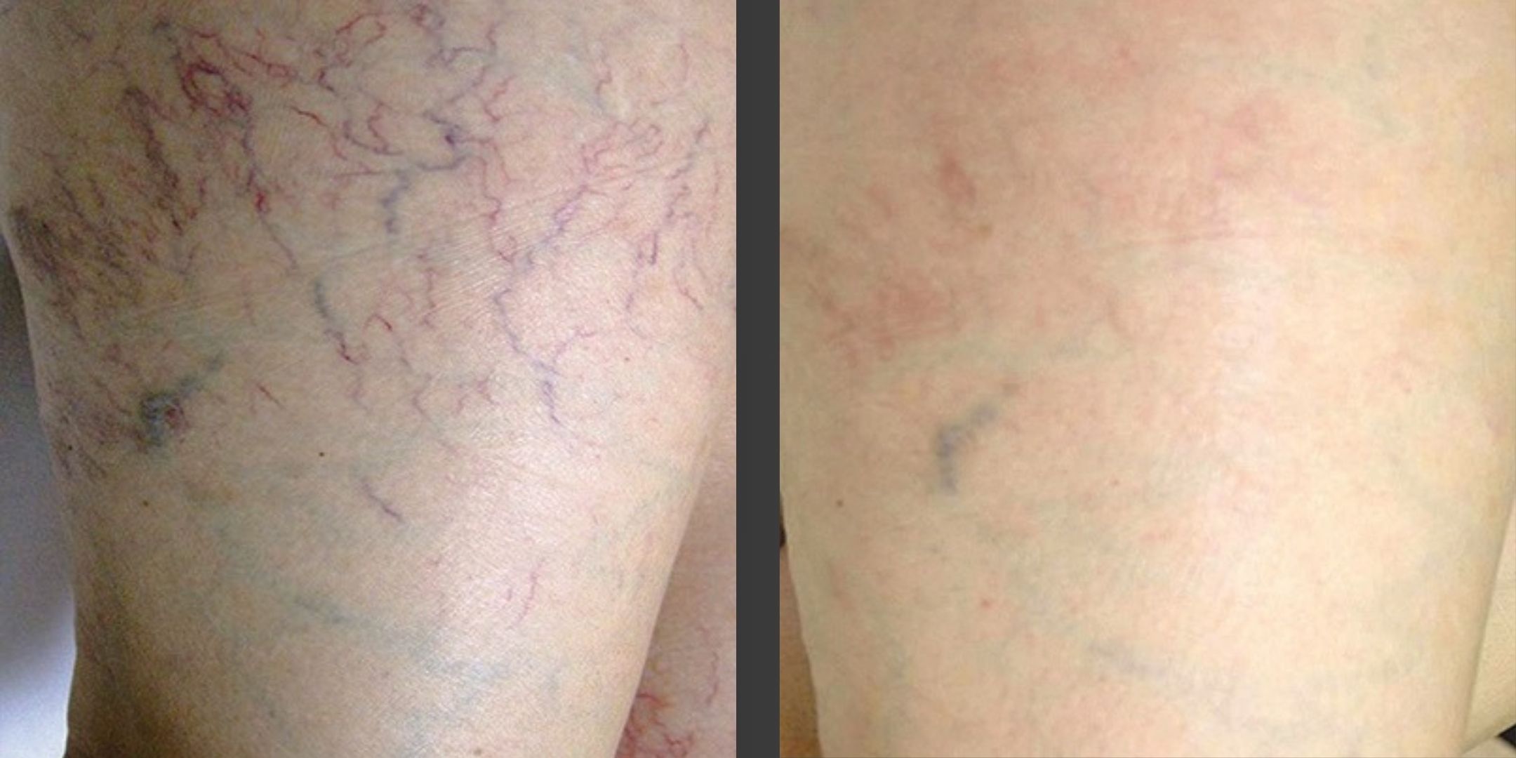 Before and after results of laser vein removal treatment in Richmond Hill, showing improvement in spider veins, varicose veins, and vascular lesions.