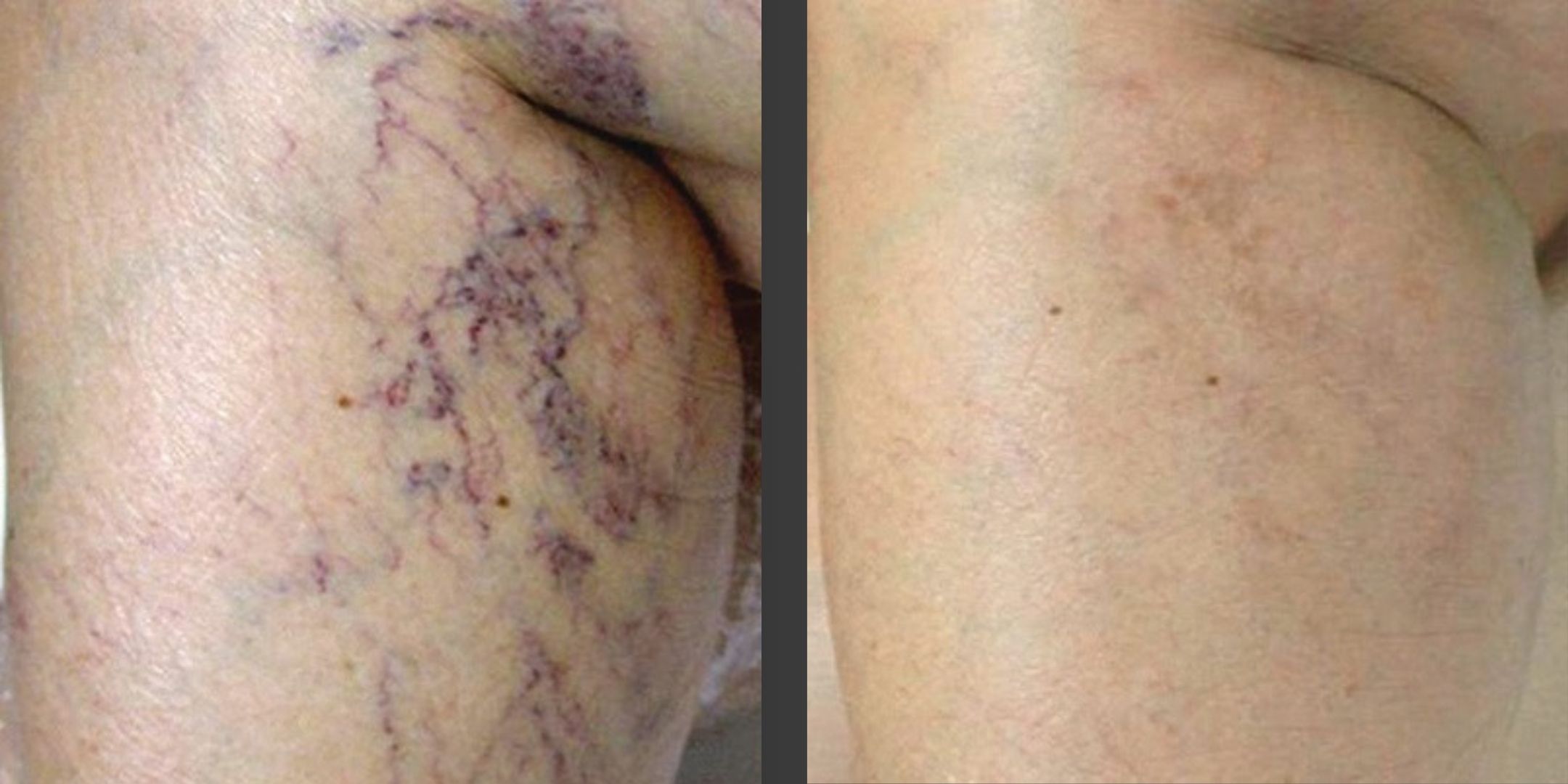 Before and after images of laser vein removal in Richmond Hill, highlighting the reduction of spider veins, varicose veins, and vascular lesions.