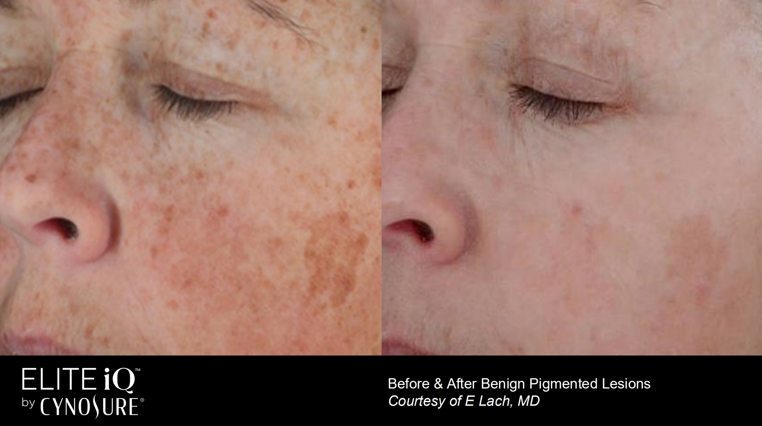 Before and After results of Benign Pigmented Lesions Stamping Facial Skin Renewal treatments in Richmond Hill