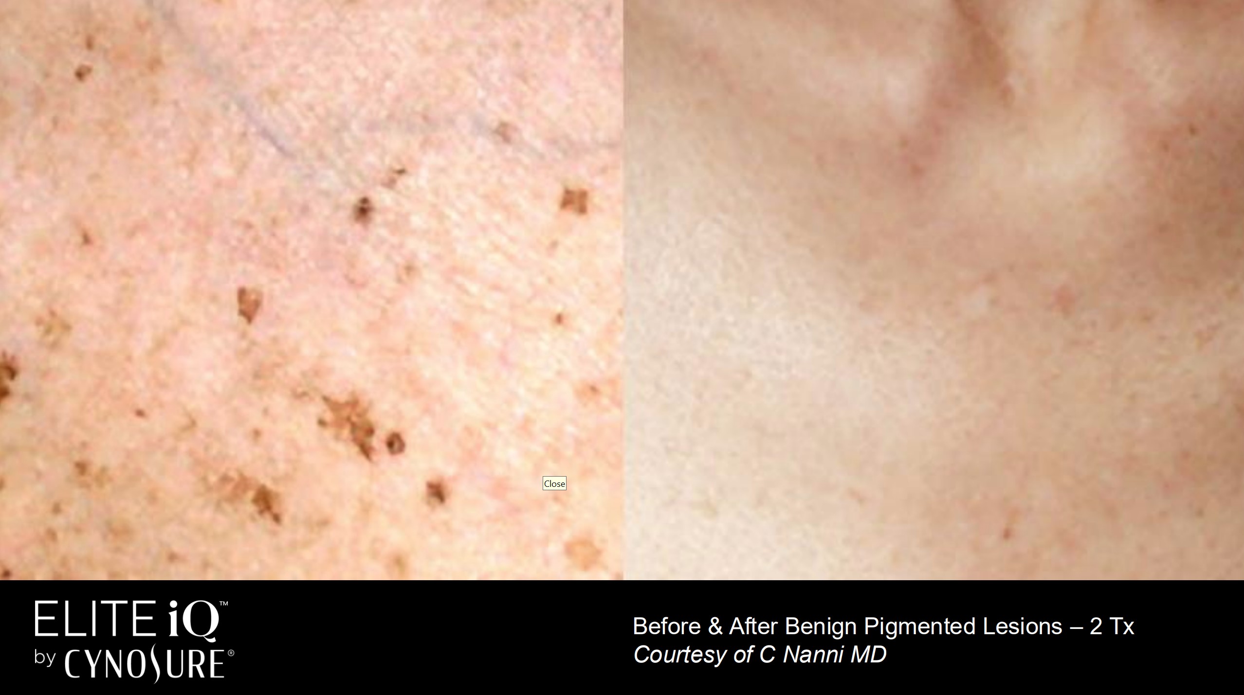 Before and After of Benign Pigmented Lesions treatment in Richmond Hill (Stamping Facial or Skin Renewal)