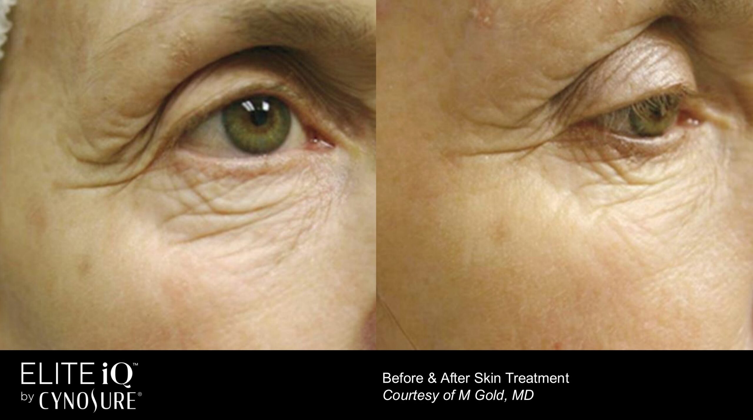 Before and After: Wrinkles Stamping Facial Skin Renewal for Pigmented Lesions and Fine Lines in Richmond Hill, ON