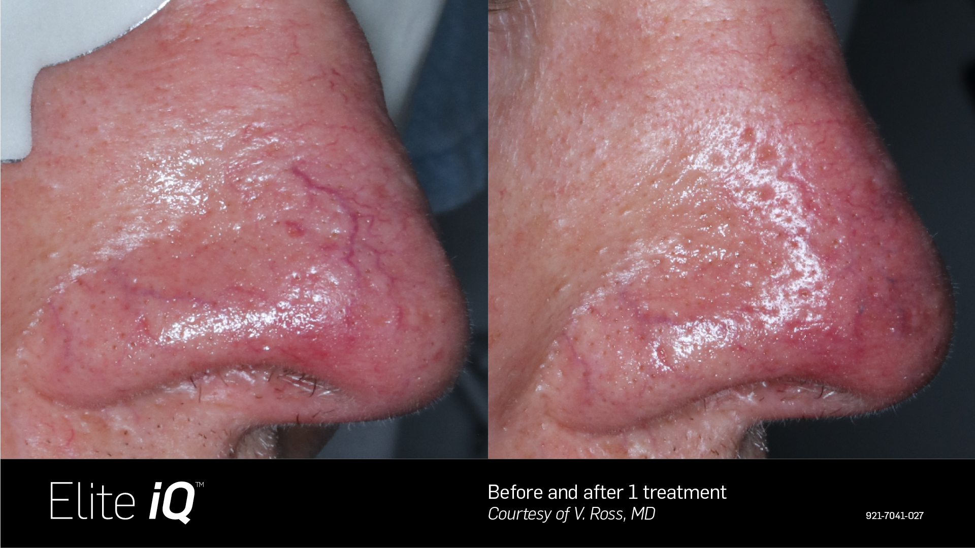 Feathering Facial - Skin Revitalization – Vascular & Pigmented Lesions in Richmond Hill