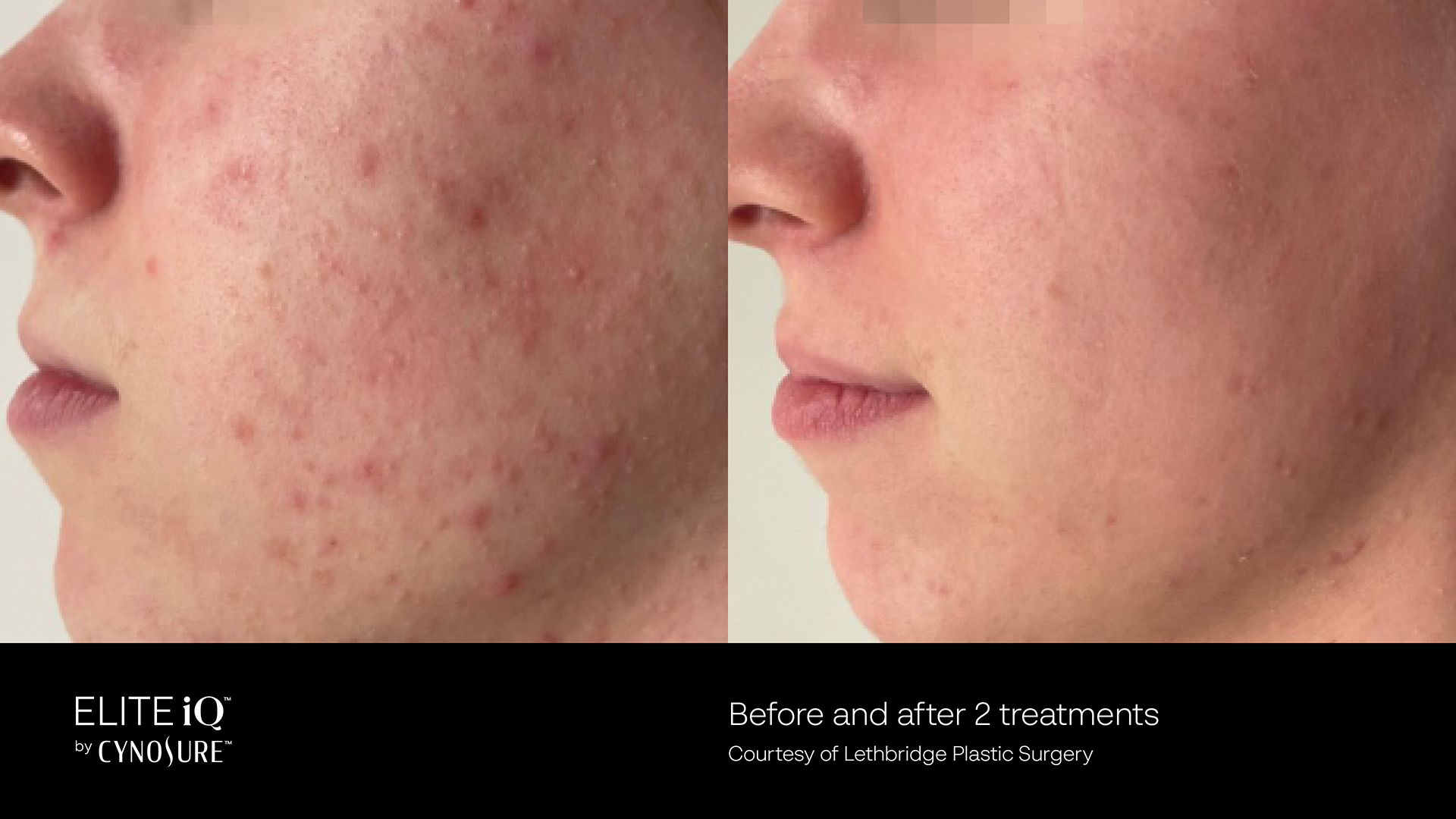 Feathering Facial - Skin Revitalization – Vascular & Pigmented Lesions in Richmond Hill