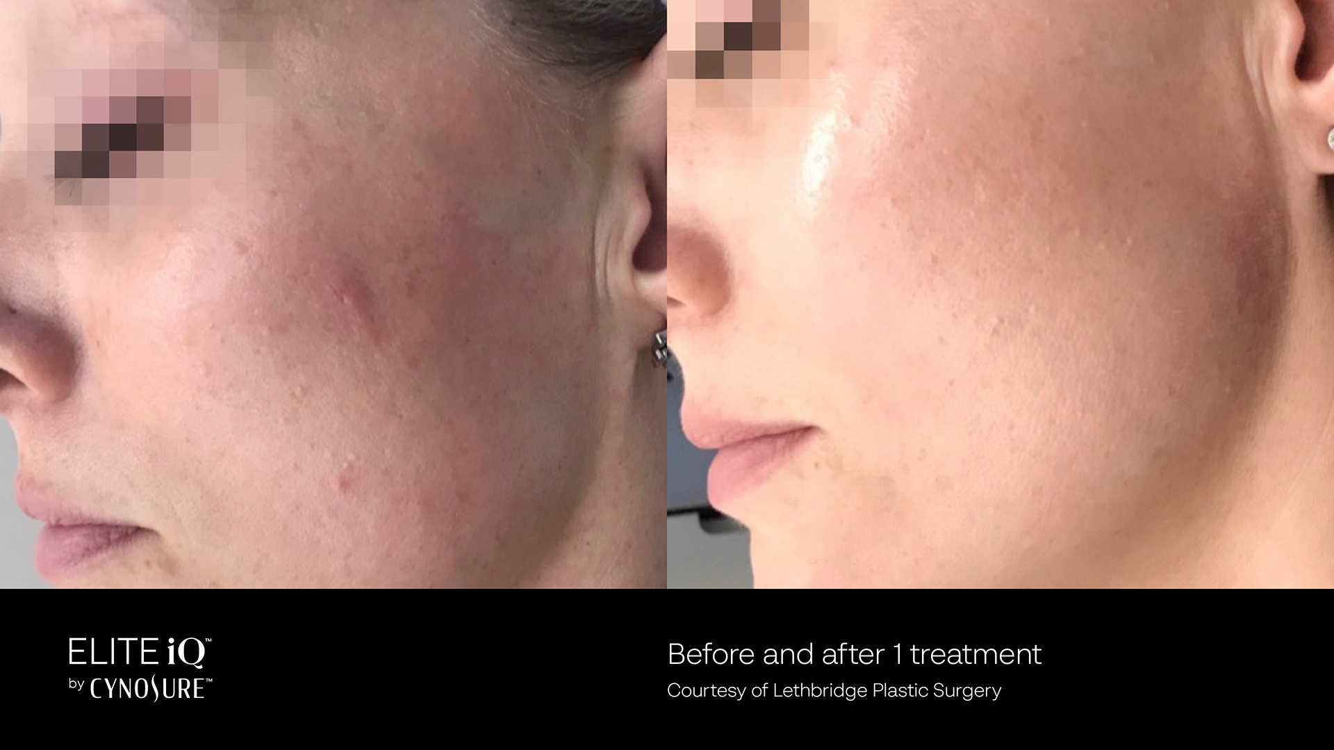 Feathering Facial - Skin Revitalization – Vascular & Pigmented Lesions in Richmond Hill