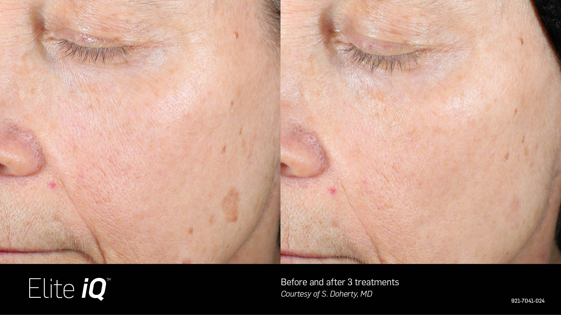 Feathering Facial - Skin Revitalization – Vascular & Pigmented Lesions in Richmond Hill