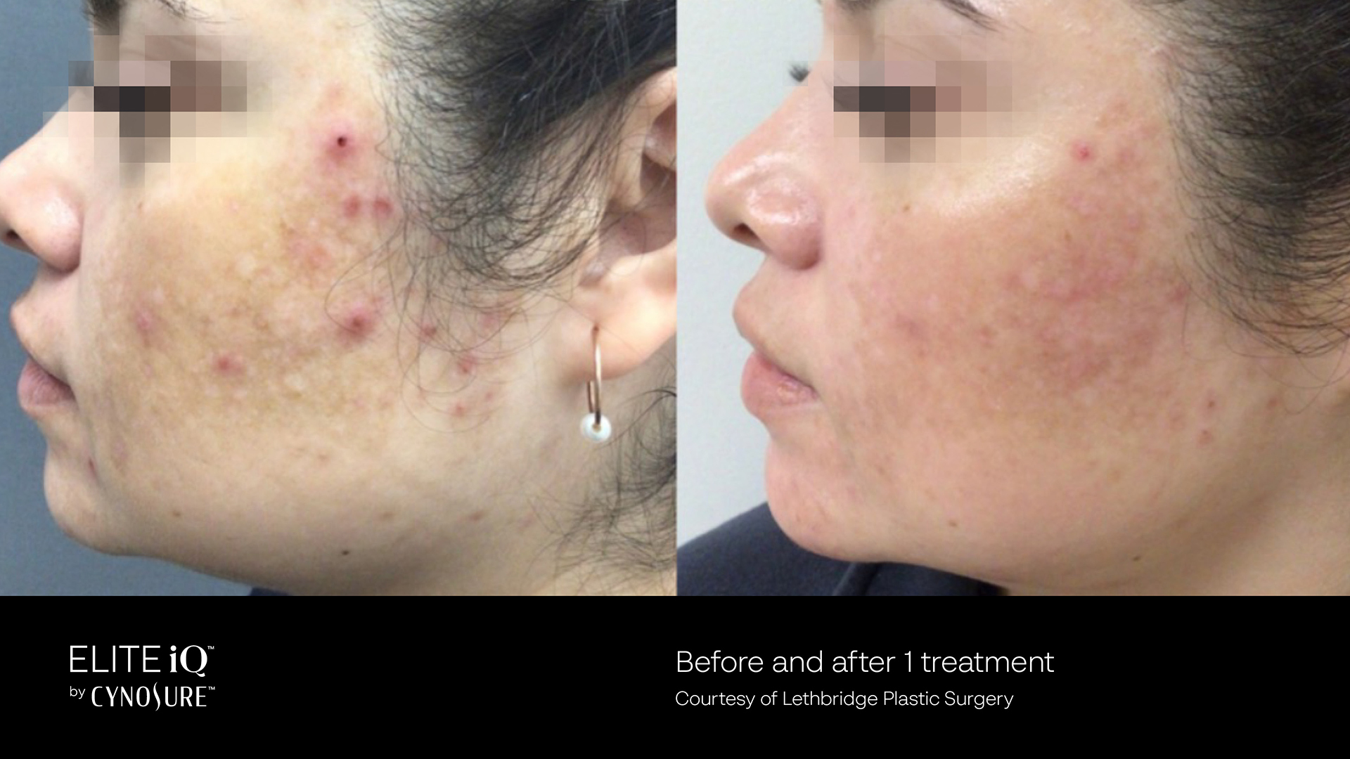 Feathering Facial - Skin Revitalization – Vascular & Pigmented Lesions in Richmond Hill