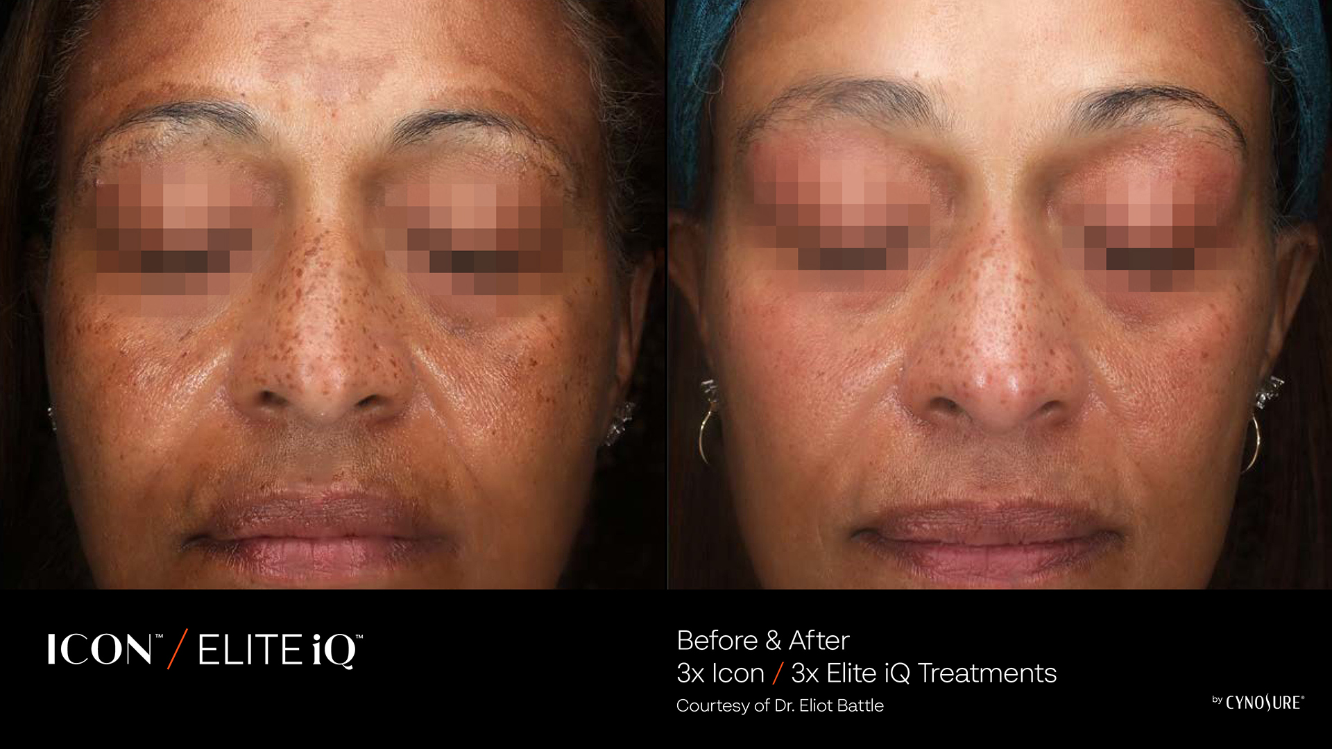 Stamping Facial Skin Renewal for Pigmented Lesions and Fine Lines