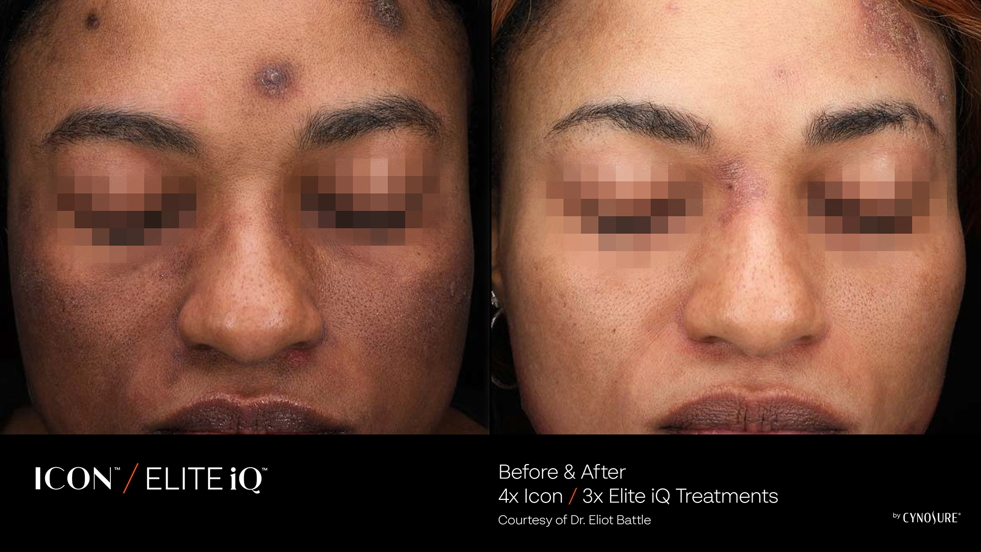 Transformative Stamping Facial for Renewing Skin Affected by Pigmented Lesions and Fine Lines in Richmond Hill