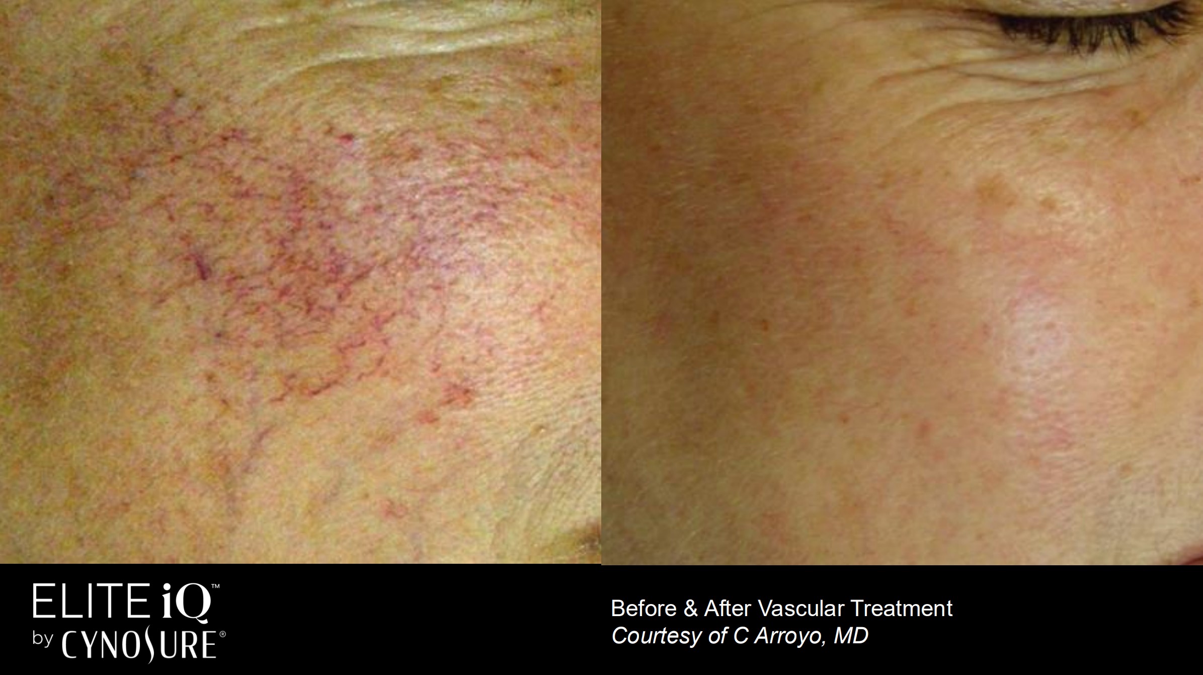 Vascular Treatment Before and After results in Richmond Hill: Feathering Facial Skin Revitalization