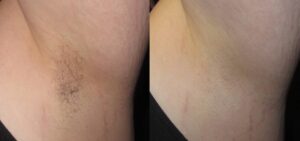 before after laser hair removal underarms richmond hill