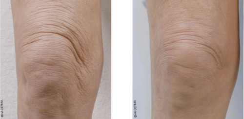 Profhilo before after result for knees