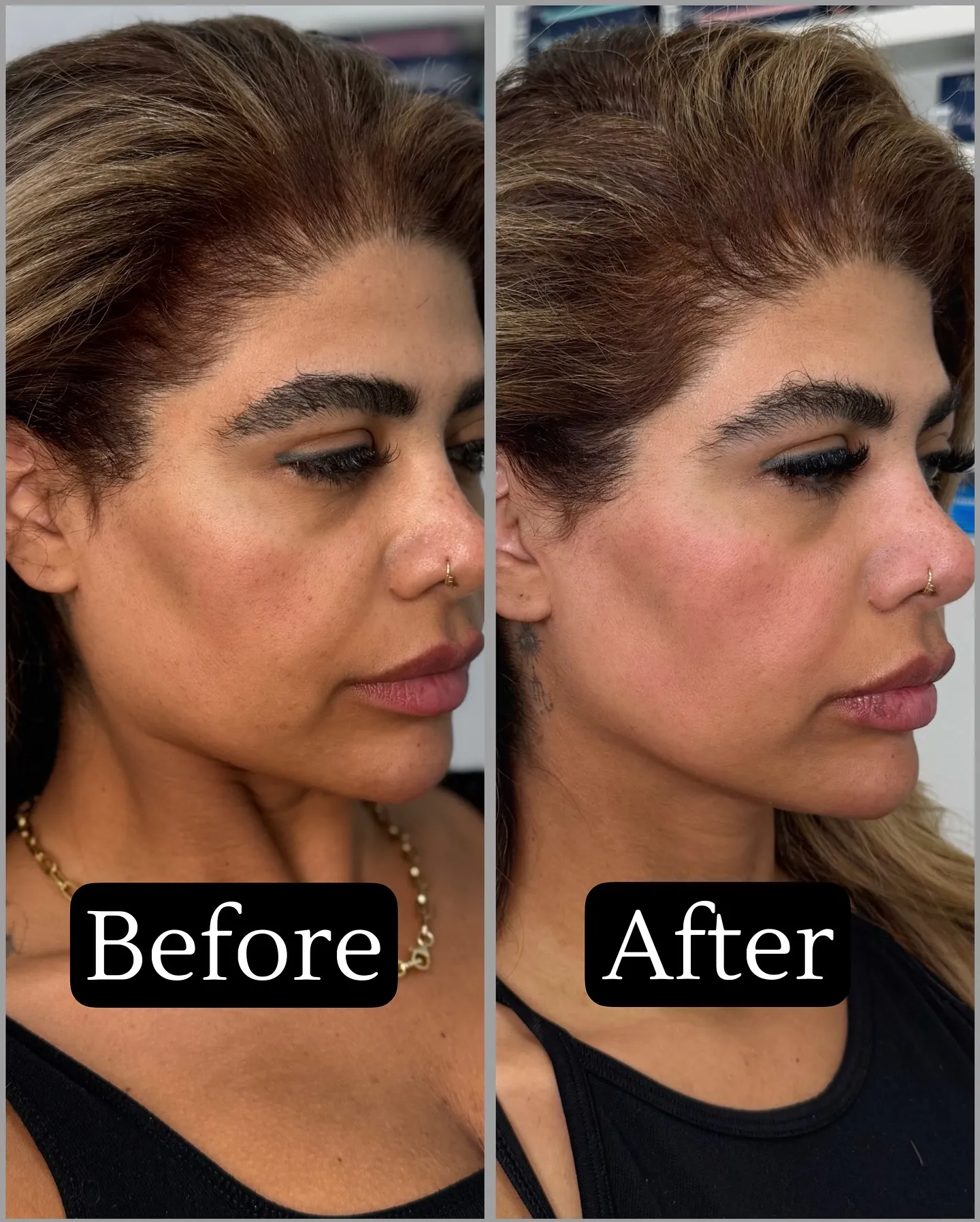 Skinpen Microneedling After 1 Session Before After Results