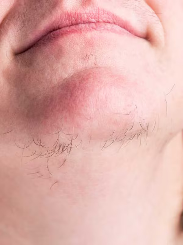 Can Laser Hair Removal Stimulate Hair Growth?