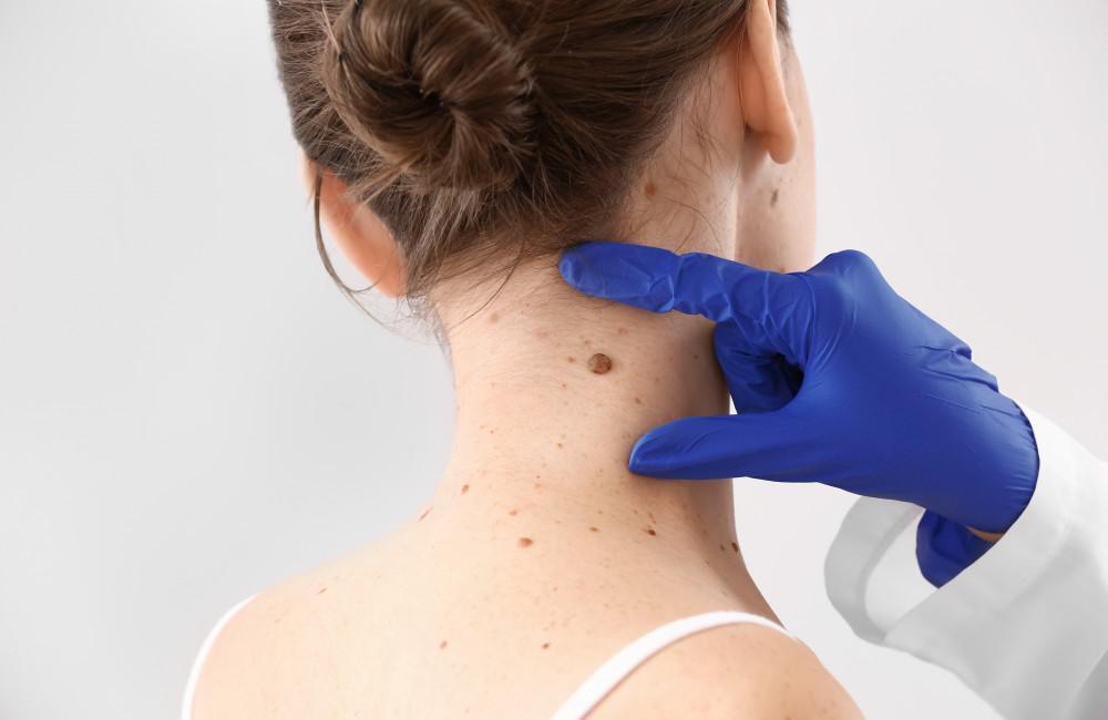Mole and Skin Tag Removal by Doctor Richmond Hill