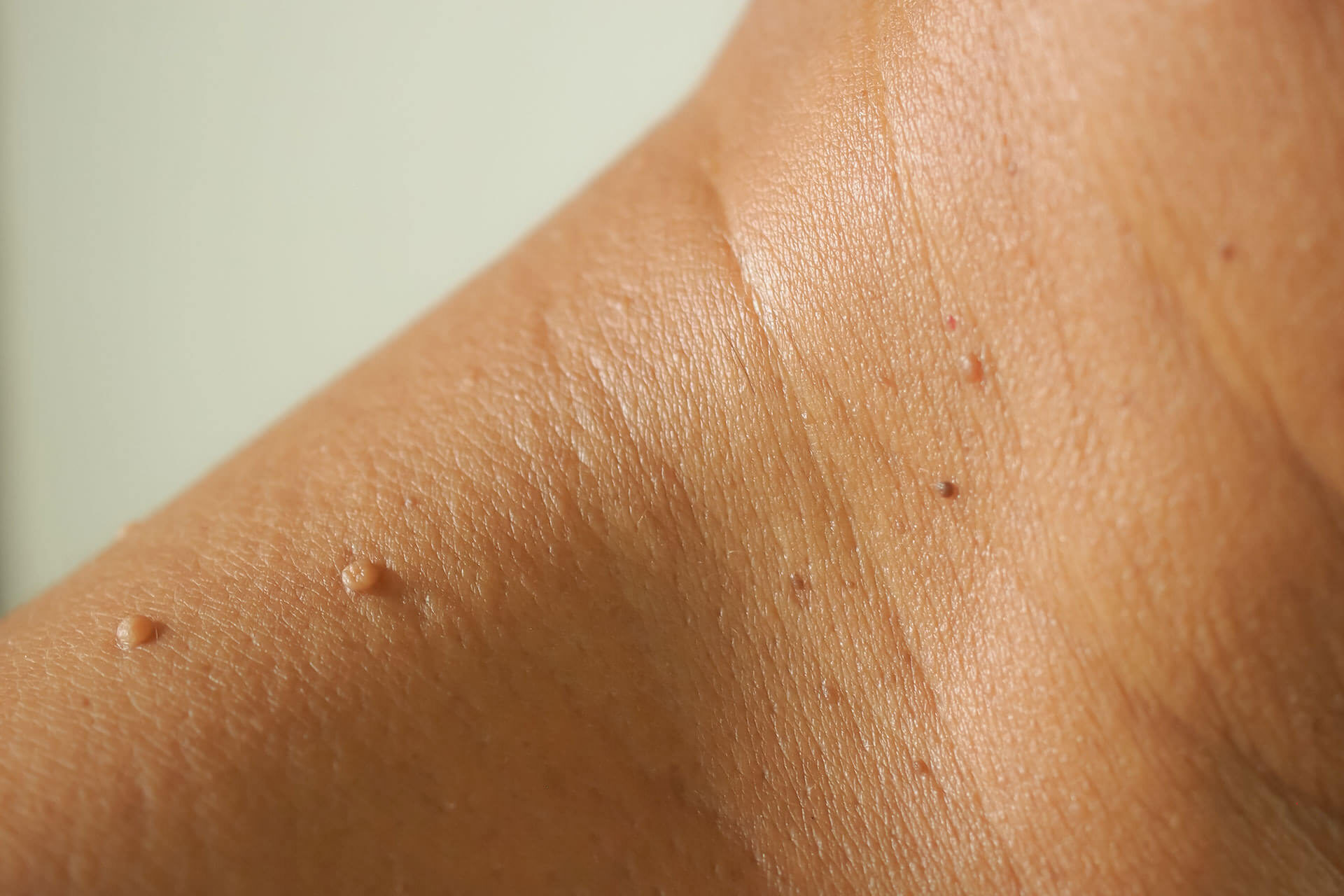 Skin Tag Removal Treatment in Richmond Hill including Moles