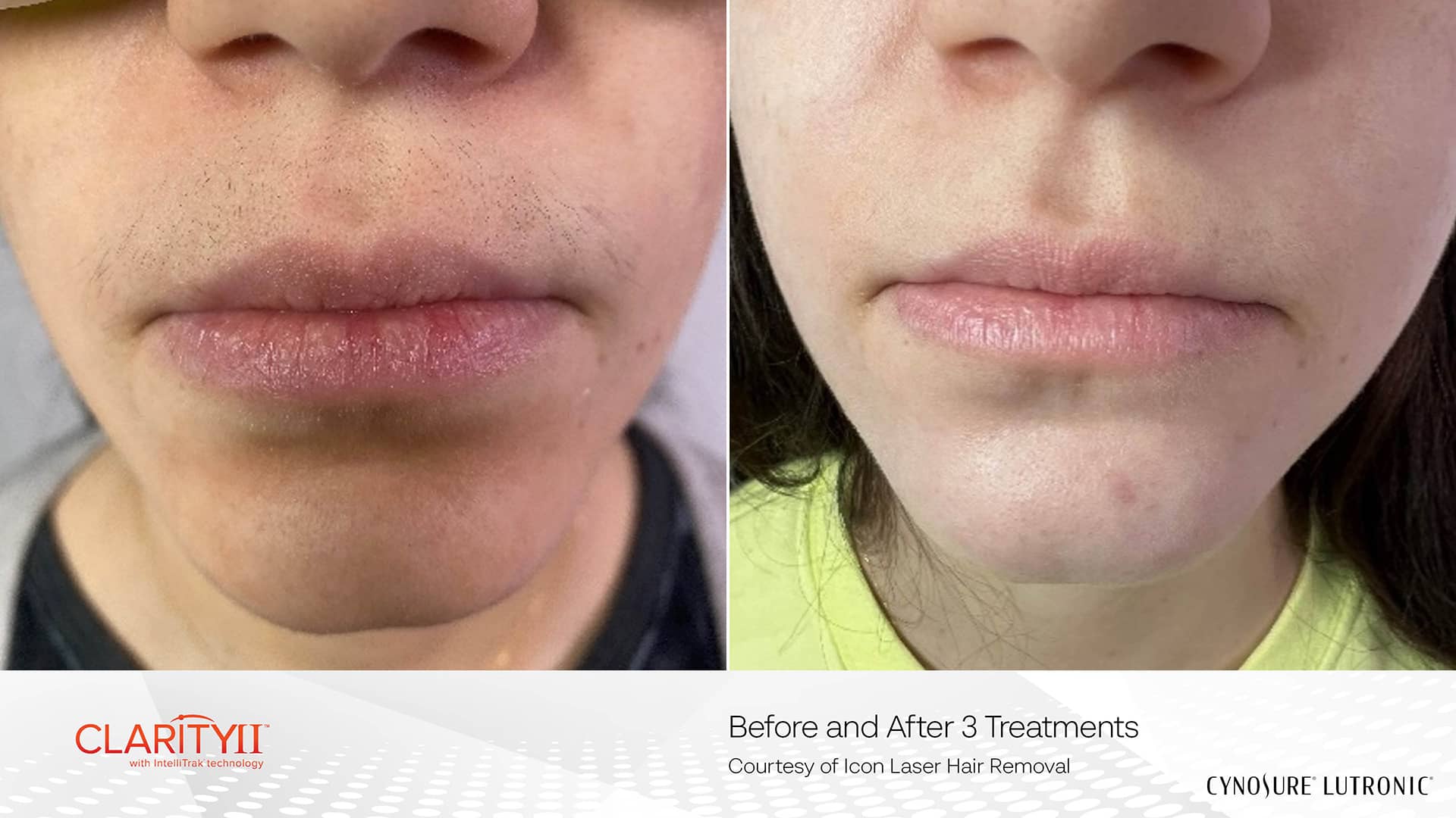 Best Laser Hair Removal Clinic in Richmond Hill for Permanent Hair Reduction 7 Facial Hair Reduction with Laser Hair Removal Device Clarity II