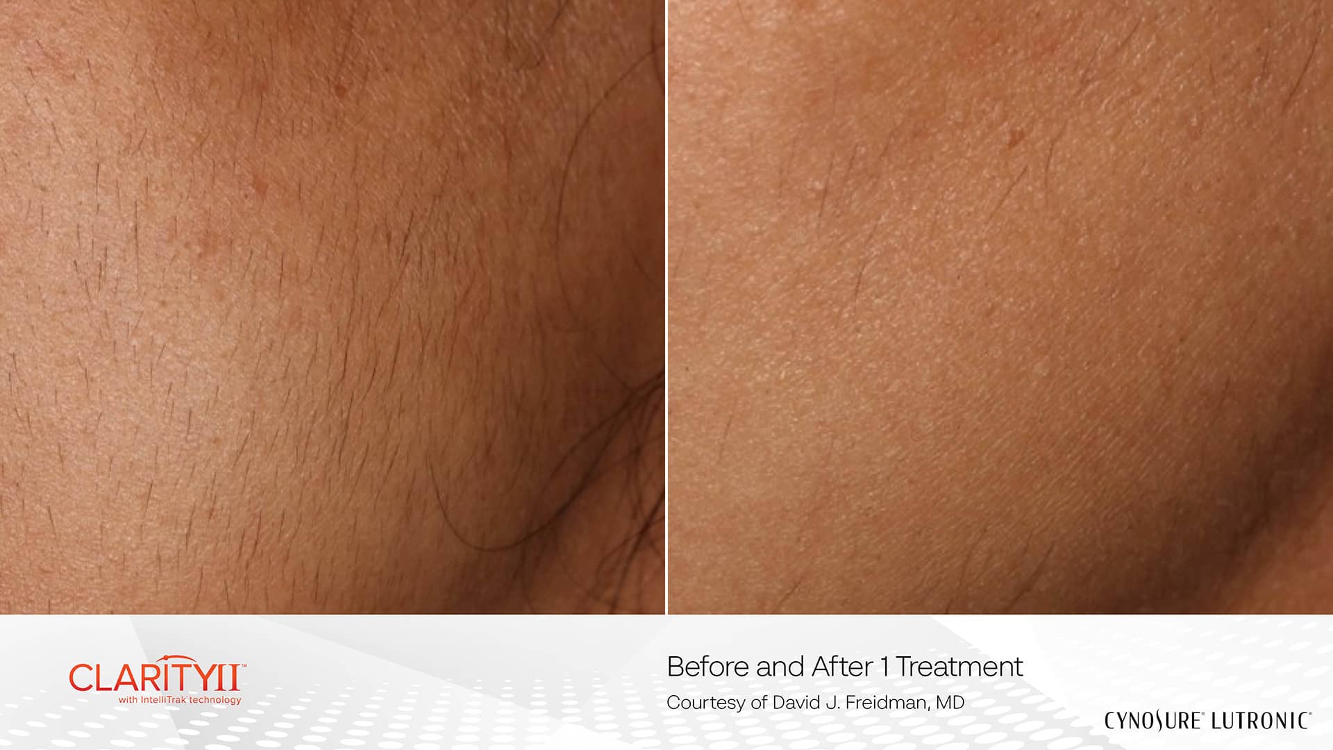 Best Laser Hair Removal Clinic in Richmond Hill for Permanent Hair Reduction 6 Fine Hair Reduction with Laser Hair Removal Device Clarity II