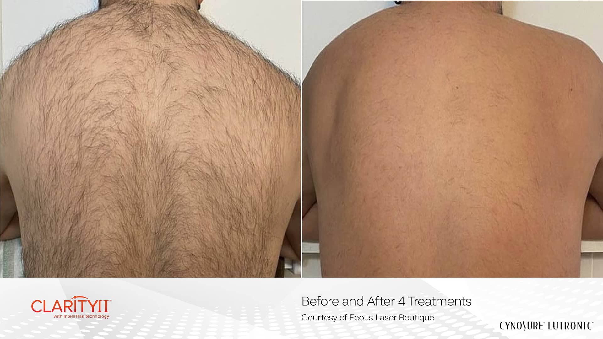 Best Laser Hair Removal Clinic in Richmond Hill for Permanent Hair Reduction 9 Men's Body Hair Removal with Laser Hair Device Clarity II Results