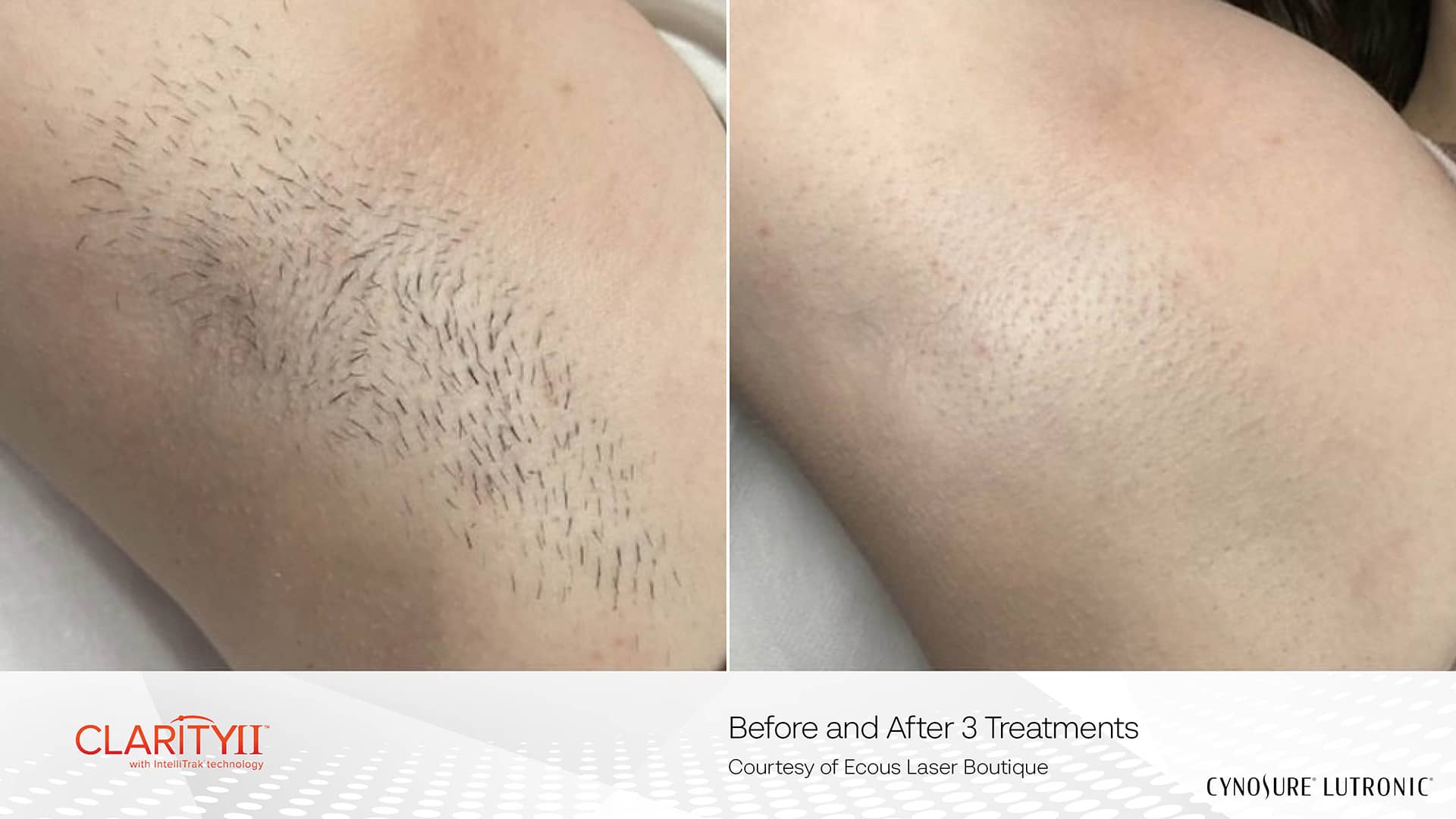 Best Laser Hair Removal Clinic in Richmond Hill for Permanent Hair Reduction 8 Underarms Hair Removal with Laser Hair Device Clarity II Results