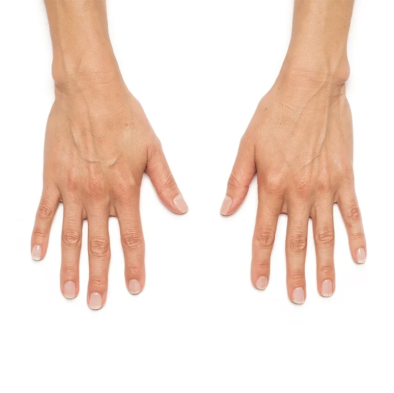 Radiesse in Richmond Hill 20 Hands, turn back the clock, before RADIESSE treatment