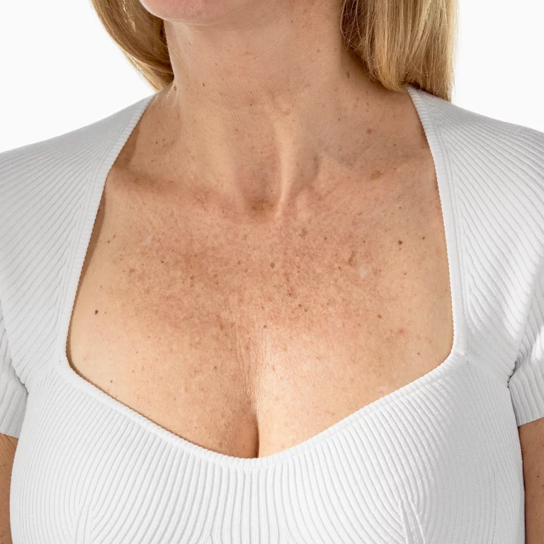 Radiesse in Richmond Hill 22 Décolleté, transformative gradual results, before RADIESSE treatment