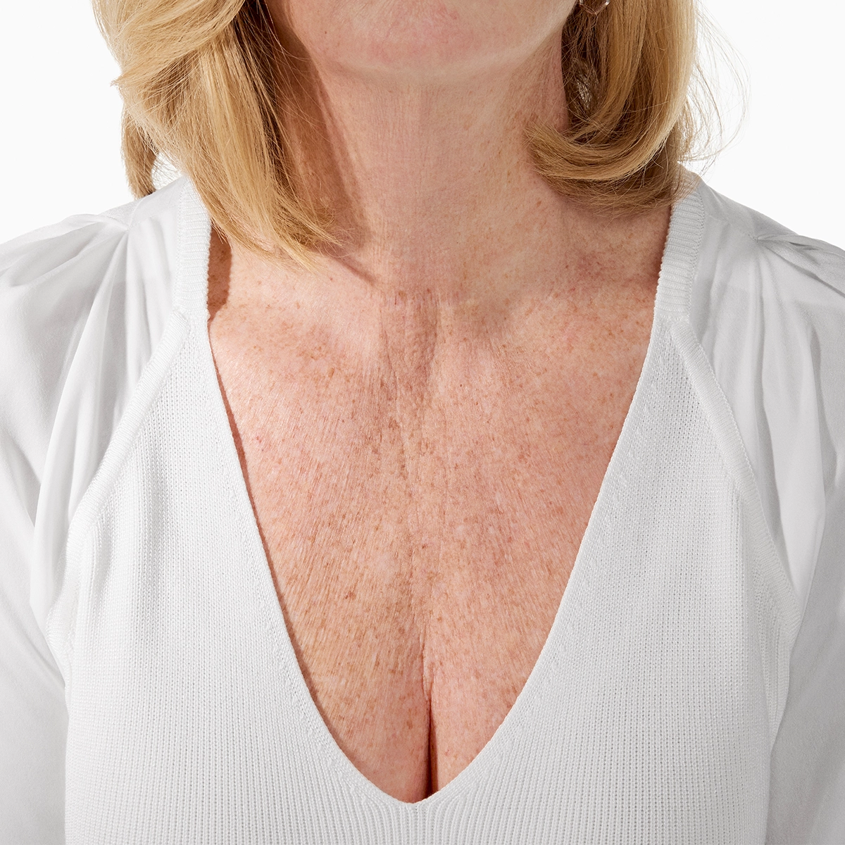 Radiesse in Richmond Hill 24 Décolleté, six months of renewal, before RADIESSE treatment