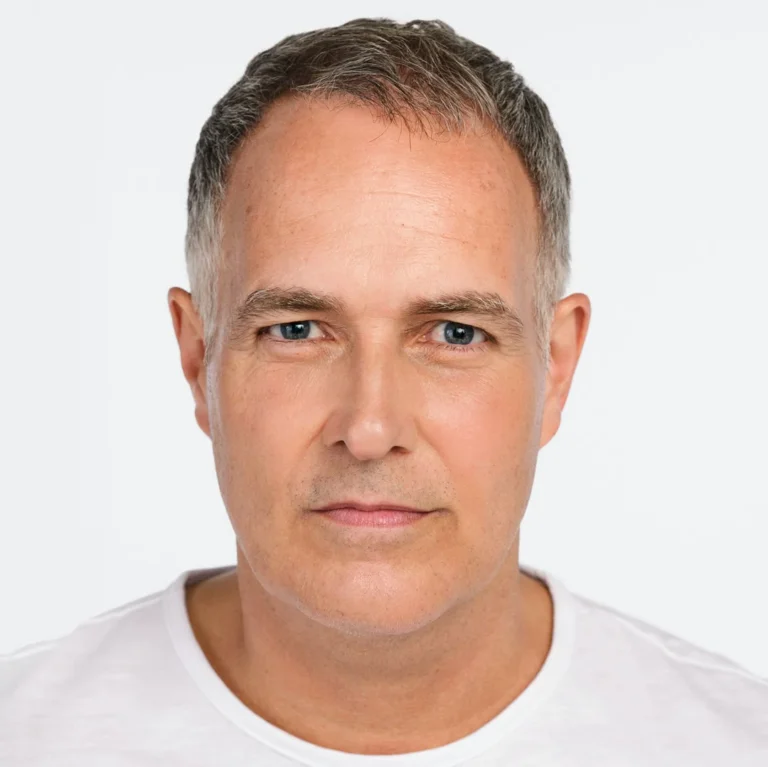 Radiesse in Richmond Hill 16 Jawline, redefined, before RADIESSE treatment