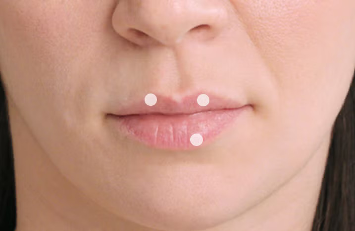 Restylane Kysse Lip Filler in Richmond Hill 7 Restylane Kysse lip filler before photo, balance corrected before volume added