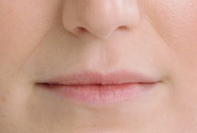 Restylane Kysse Lip Filler in Richmond Hill 11 Restylane Kysse lip filler before photo, soft hydration, no obvious work