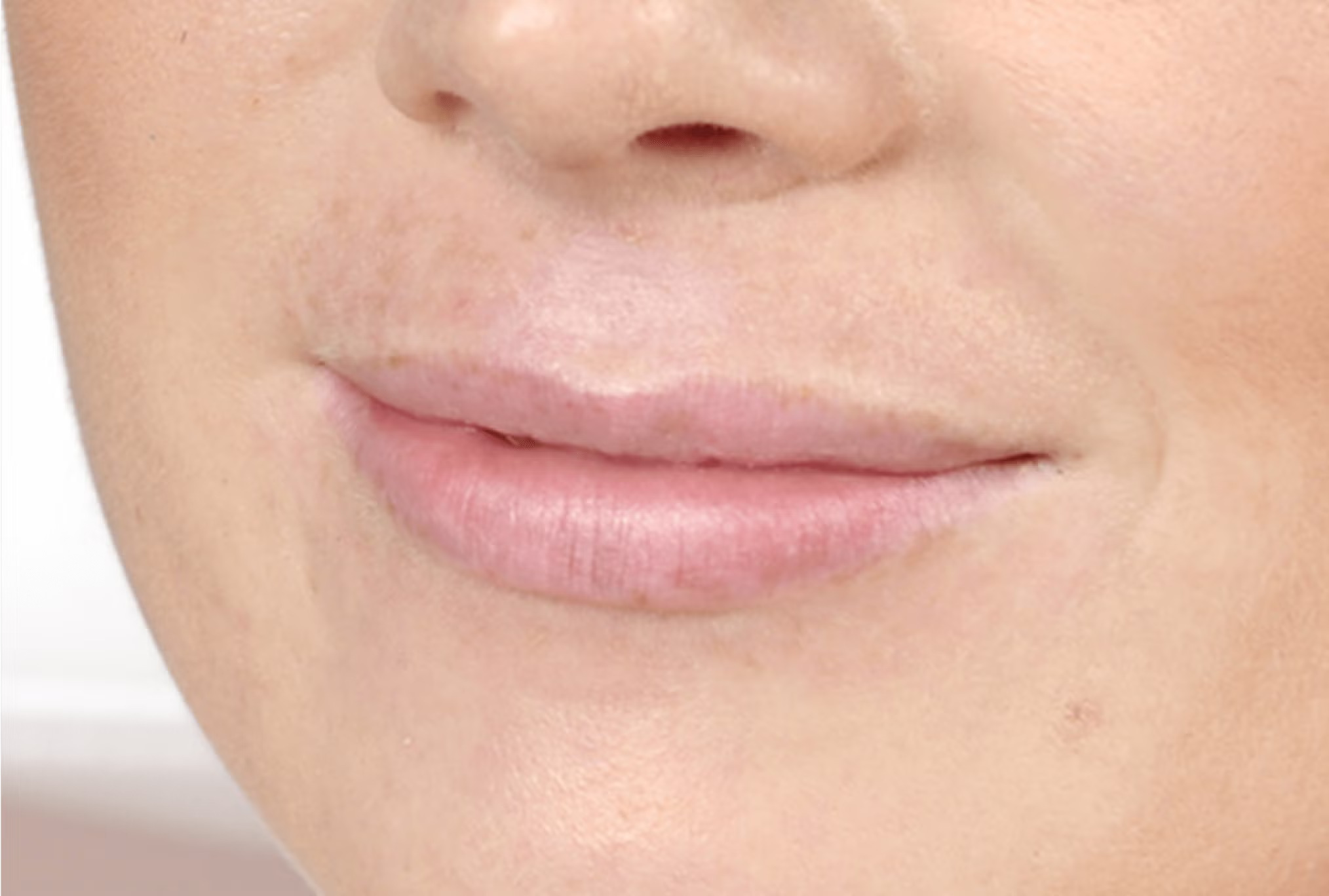 Restylane Kysse Lip Filler in Richmond Hill 9 Restylane Kysse lip filler before photo, definition back at the edges